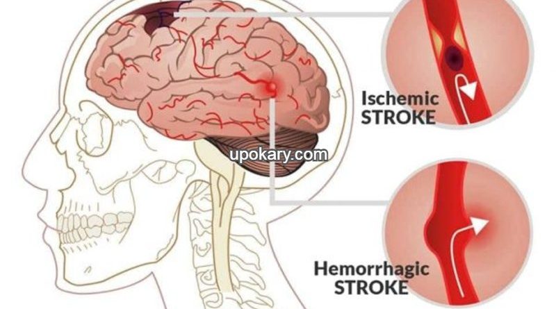Causes of stroke