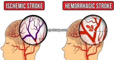 causes of stroke