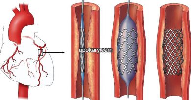 Angioplasty or Stent