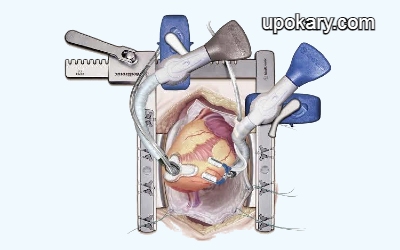 Off-pump surgery 